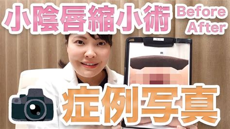 小陰唇縮小術｜びらびらを切除する婦人科形成｜新宿駅前婦人科 